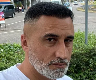 After — Hair Transplant
