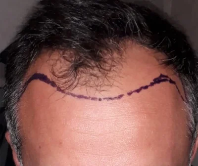 Before — Hair Transplant