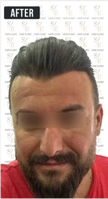 After — Hair Transplant