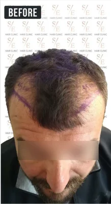 Before — Hair Transplant