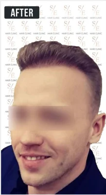 After — Hair Transplant