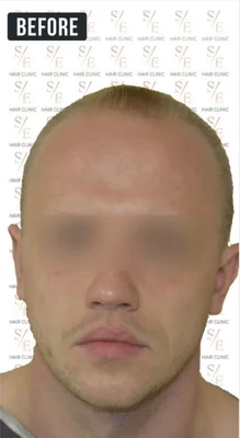 Before — Hair Transplant