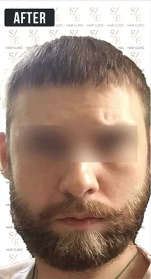 After — Hair Transplant