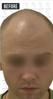 Before — Hair Transplant