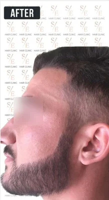 After — Beard Transplant