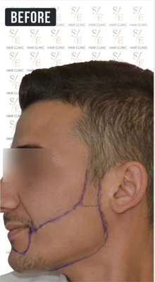 Before — Beard Transplant