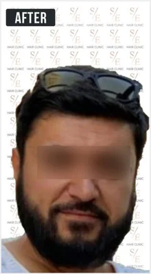After — Beard Transplant