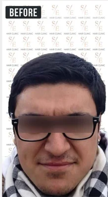 Before — Beard Transplant