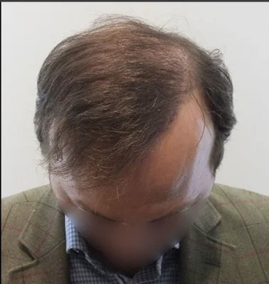 After — Hair Transplant