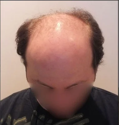 Before — Hair Transplant