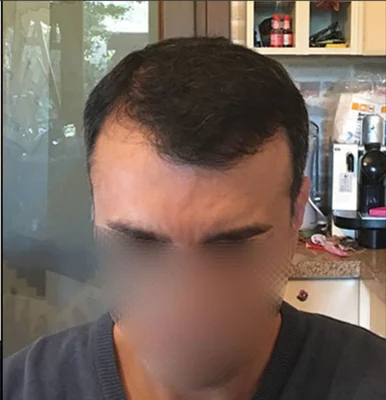 After — Hair Transplant