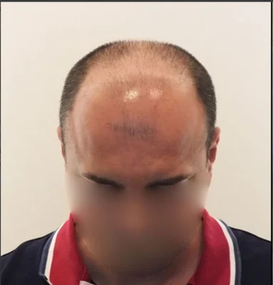 Before — Hair Transplant
