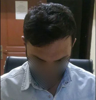 After — Hair Transplant