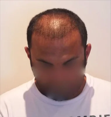 Before — Hair Transplant