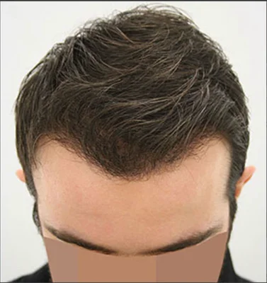 After — Hair Transplant