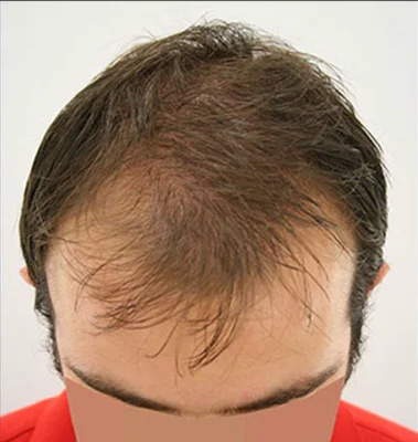Before — Hair Transplant