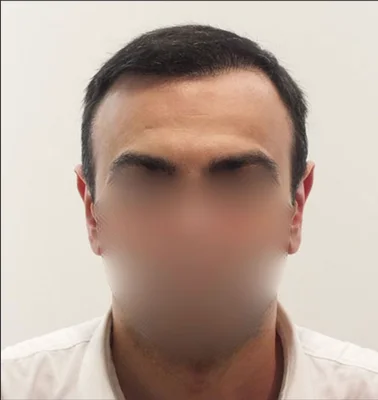 After — Hair Transplant