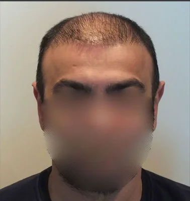 Before — Hair Transplant