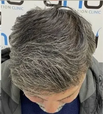 After — Hair Transplant
