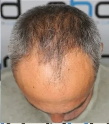 Before — Hair Transplant
