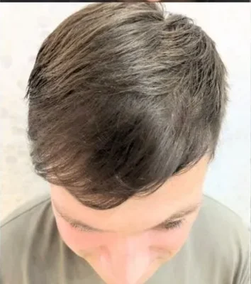 After — Hair Transplant