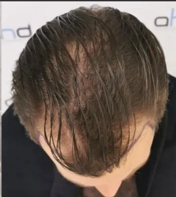 Before — Hair Transplant