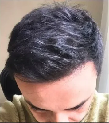 After — Hair Transplant