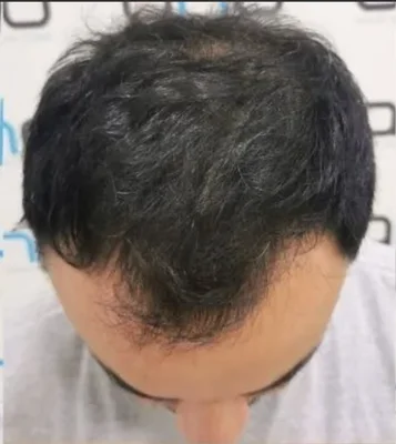 Before — Hair Transplant