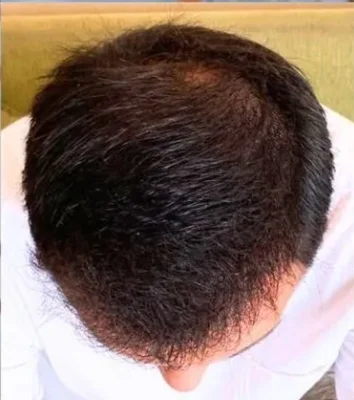 After — Hair Transplant