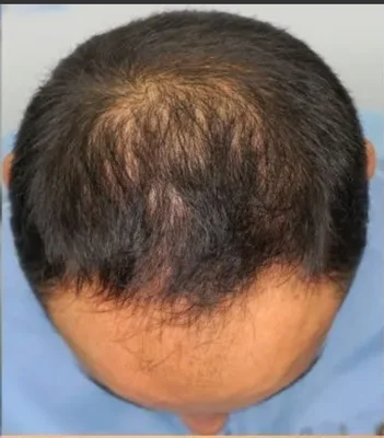 Before — Hair Transplant