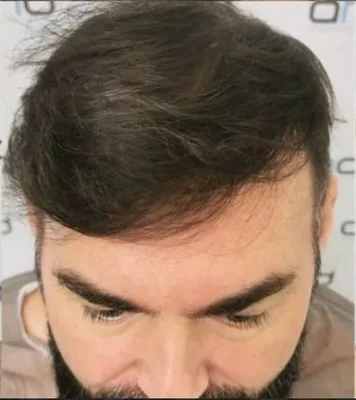 After — Hair Transplant