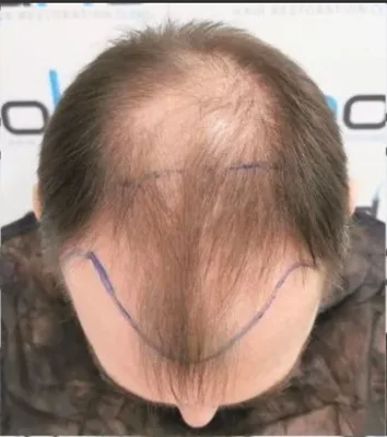 Before — Hair Transplant
