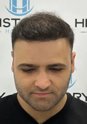 After — Hair Transplant