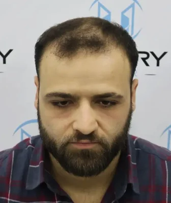 Before — Hair Transplant