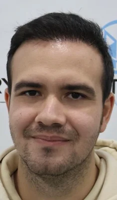 After — Hair Transplant