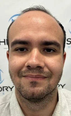 Before — Hair Transplant