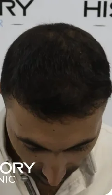 After — Hair Transplant
