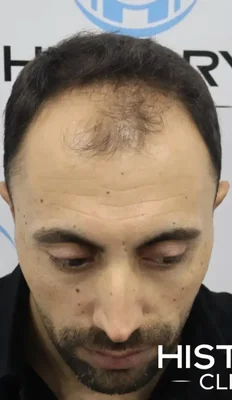 Before — Hair Transplant