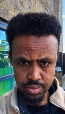 After — Hair Transplant