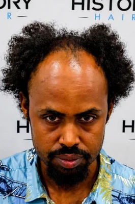 Before — Hair Transplant